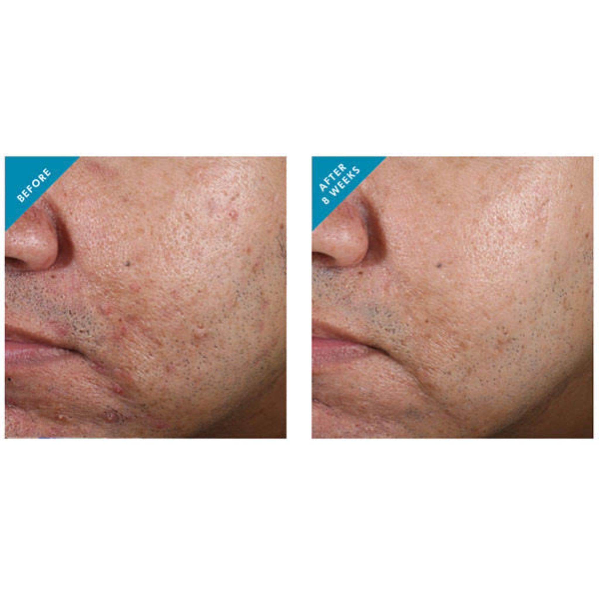 SkinCeuticals Blemish + Age Defense