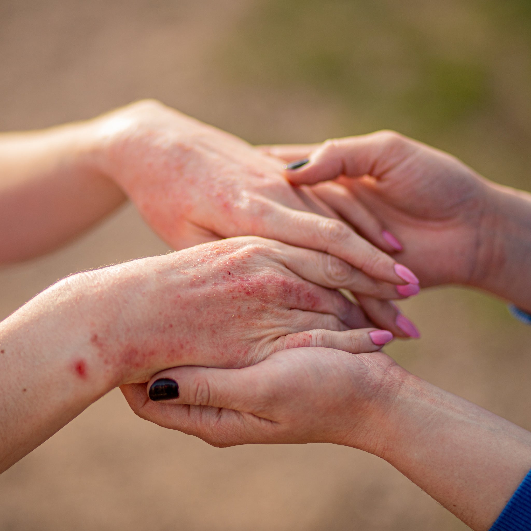 Atopic Dermatitis (Eczema)
