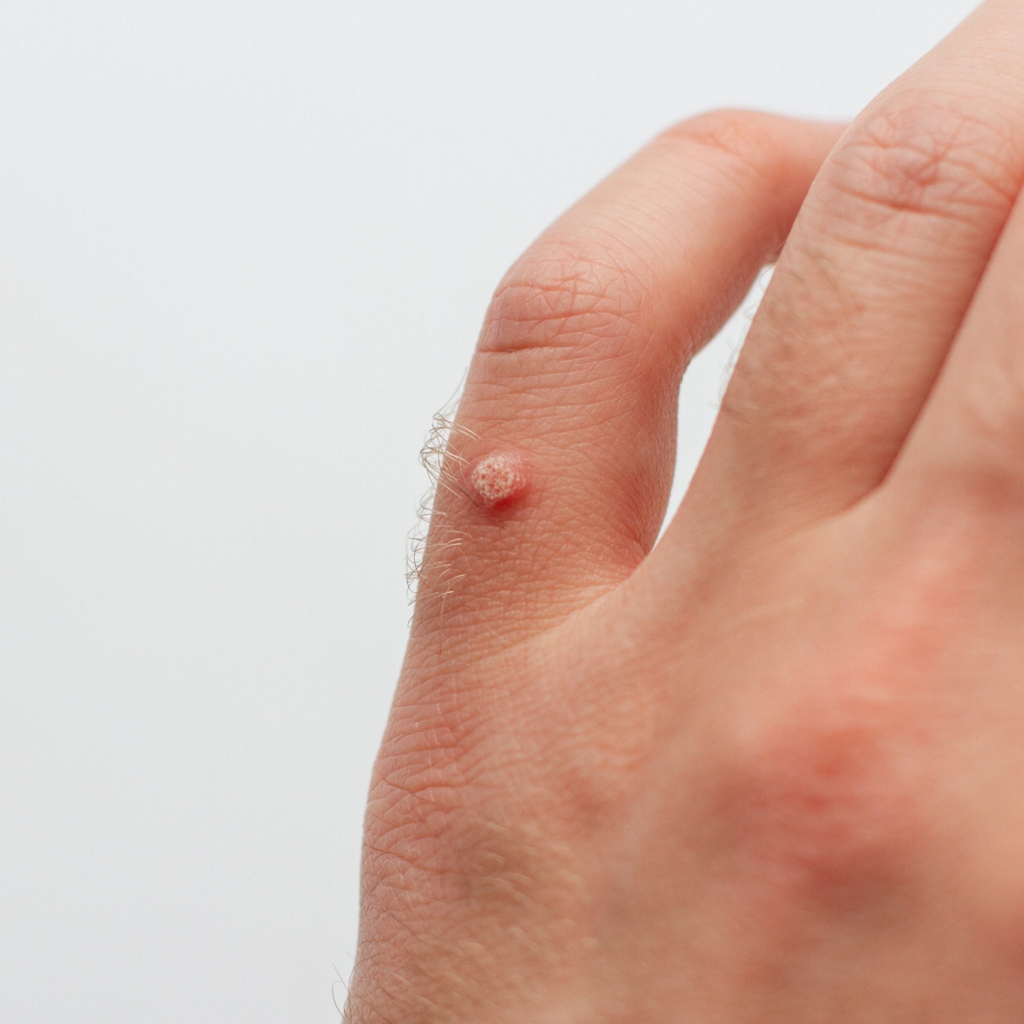 Common Warts (Verruca Vulgaris)