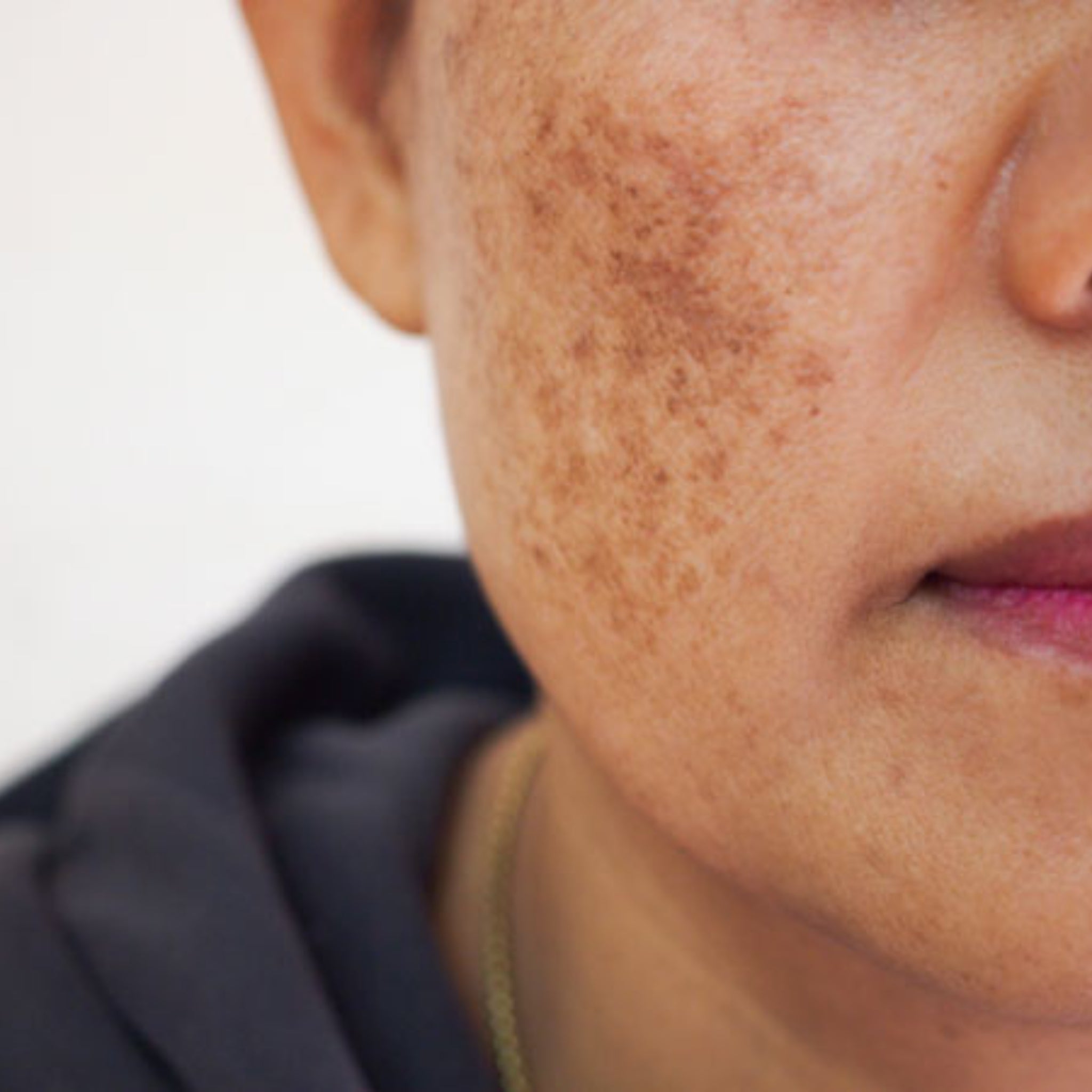 Melasma