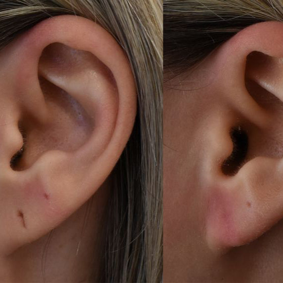 Earlobe Repair