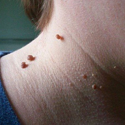 Skin Tags