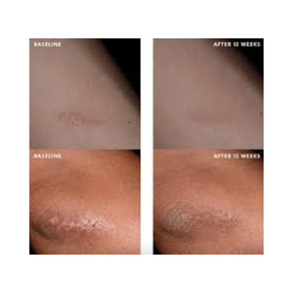 SkinCeuticals Advanced Scar Control