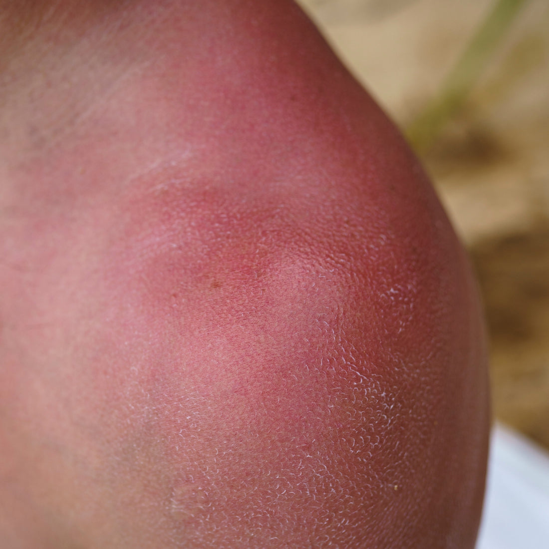 Rosacea