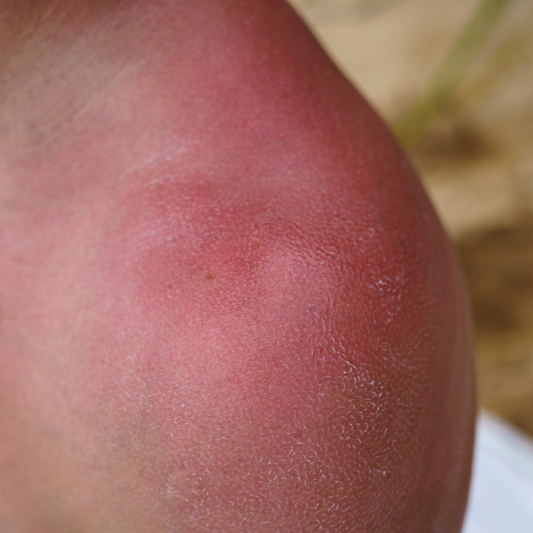 Rosacea