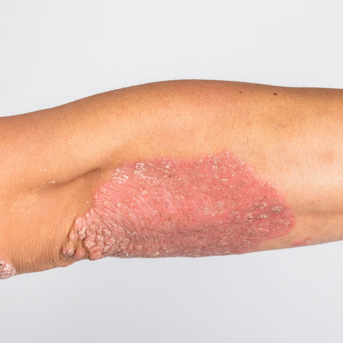Psoriasis