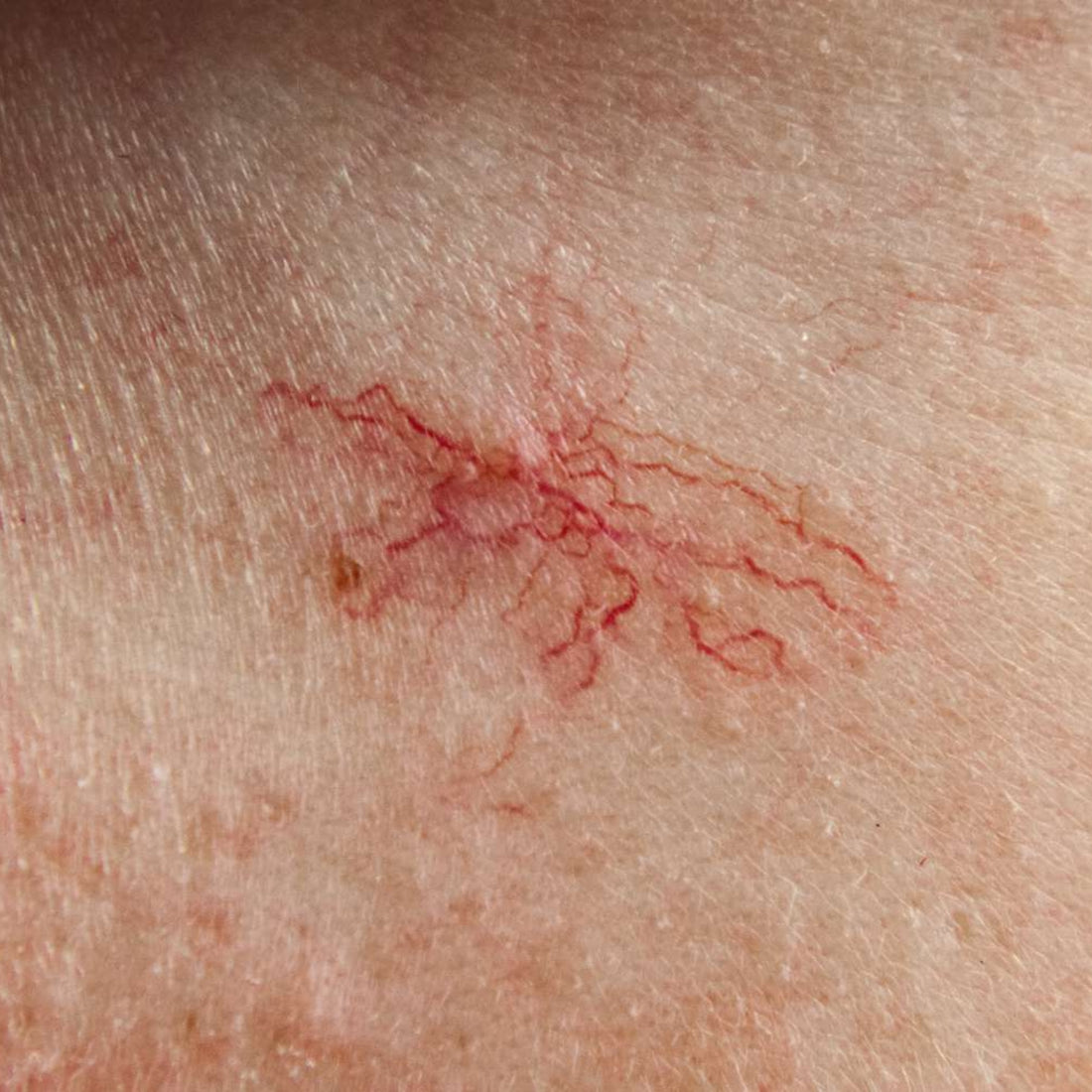 Cherry Angioma/Spider Angioma