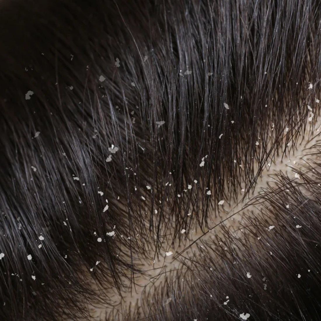 Seborrheic Dermatitis