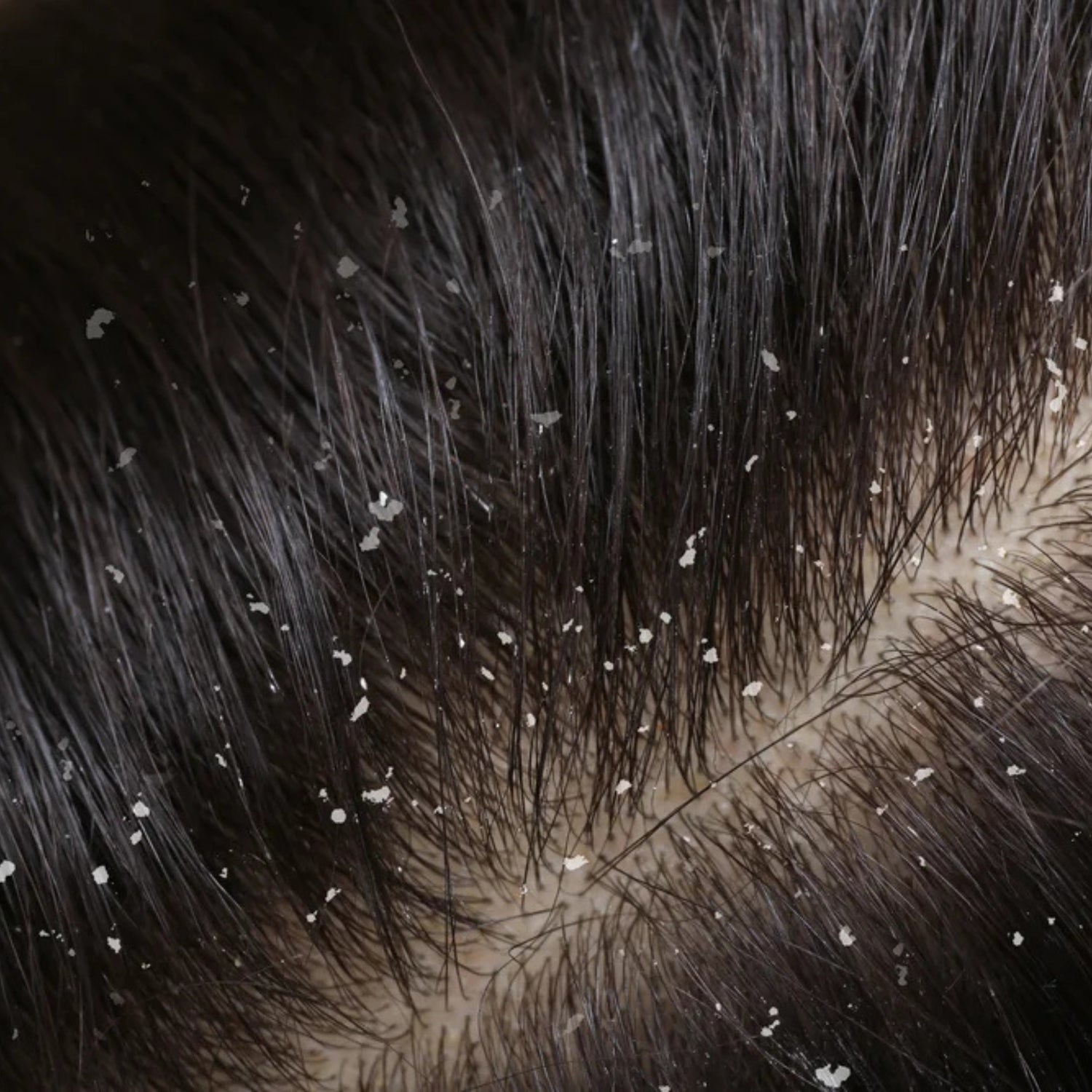 Seborrheic Dermatitis