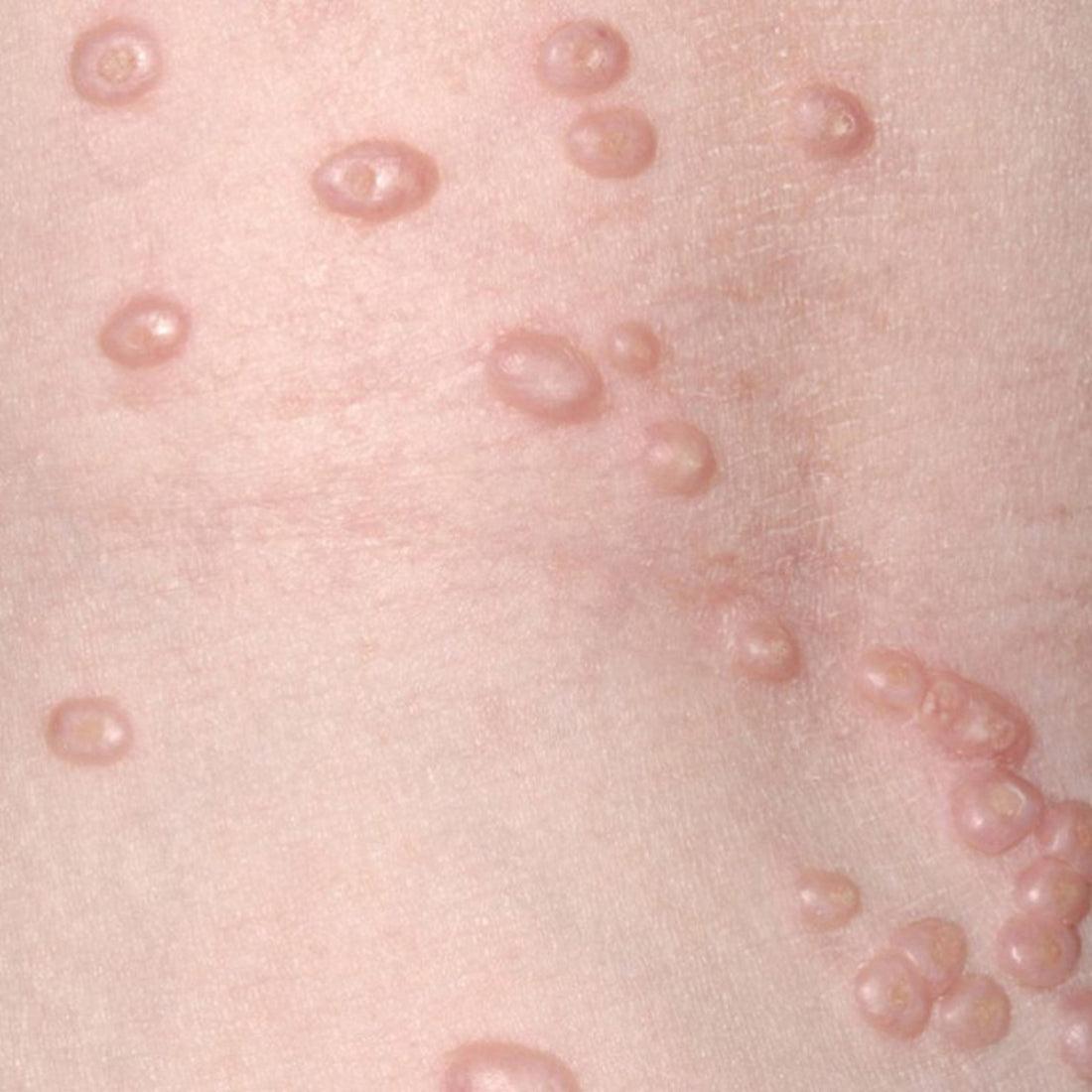 Molluscum Contagiosum