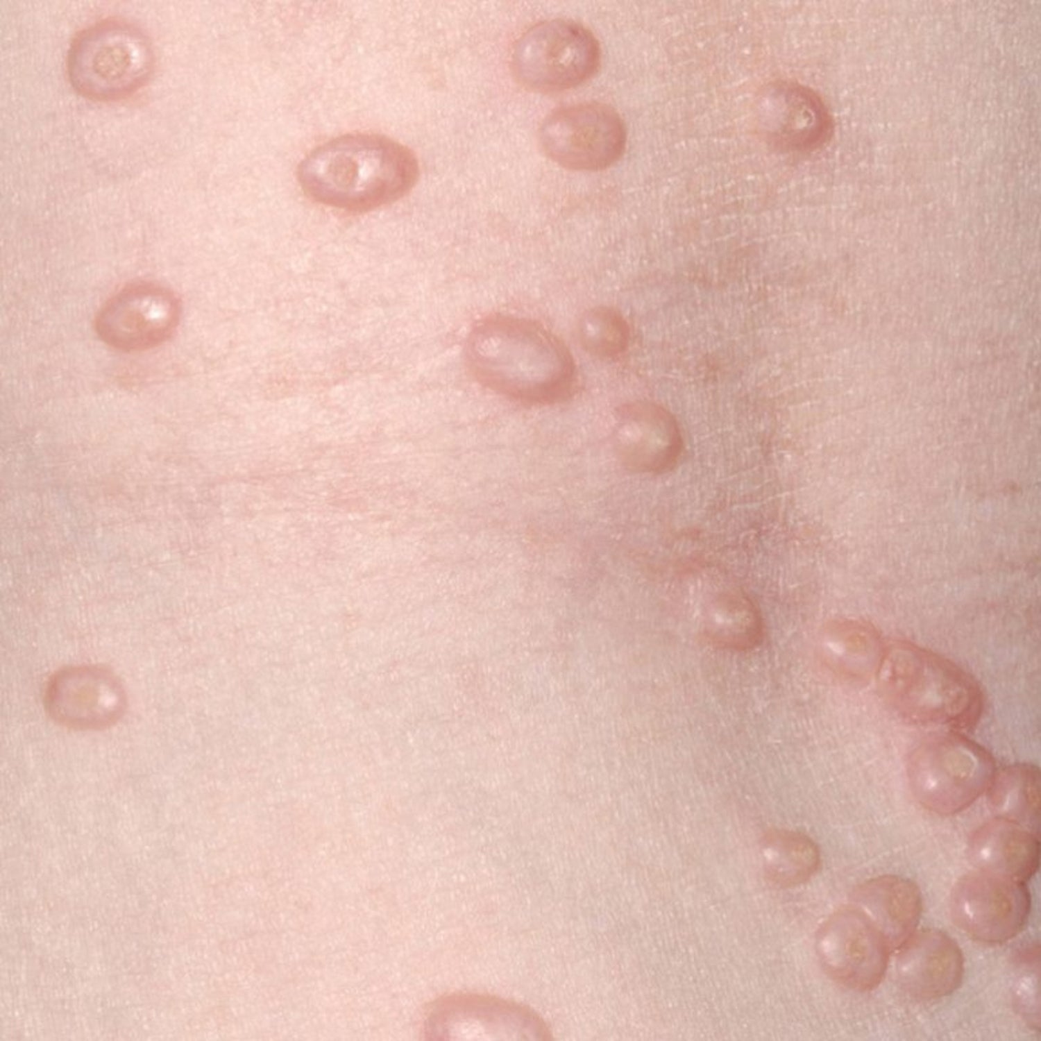 Molluscum Contagiosum